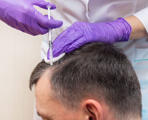 PRP- Hair Restoration PRP- Hair Restoration